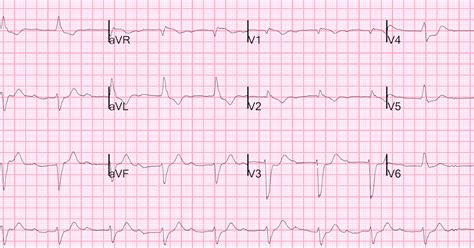 Dr. Smith's ECG Blog: Acute Pulmonary Edema, PEA Arrest, LBBB, First ...