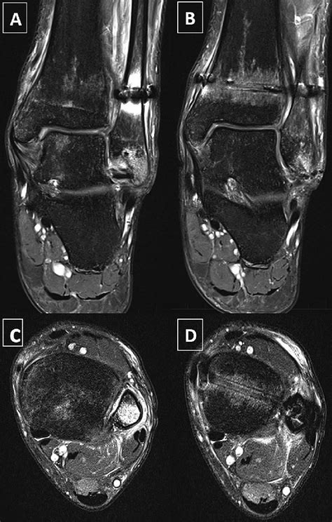 (A and B) Coronal and (C and D) axial MRI images of bone marrow edema ...