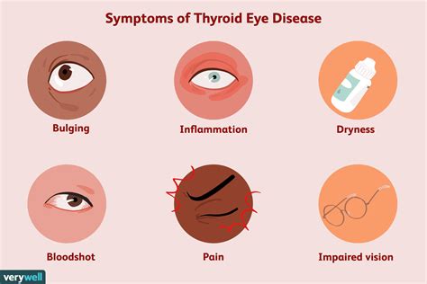 Thyroid Eye Disease: Signs, Symptoms, and Complications