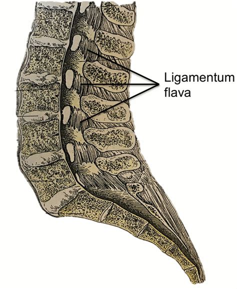 Ligamentum Flavum - Ossification Of The Ligamentum Flavum In The Upper ...