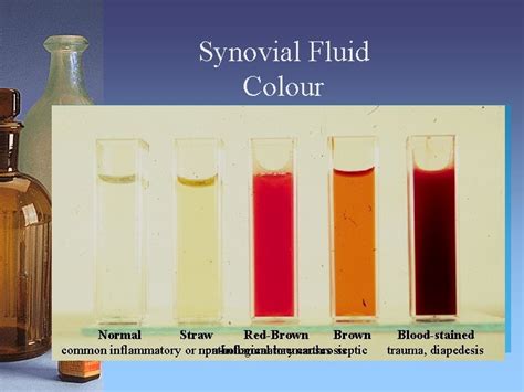 Serous Effusions how the clinical biochemistry lab can