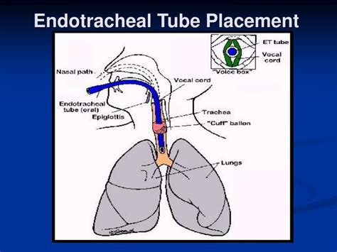 Endotracheal Tube Anatomy