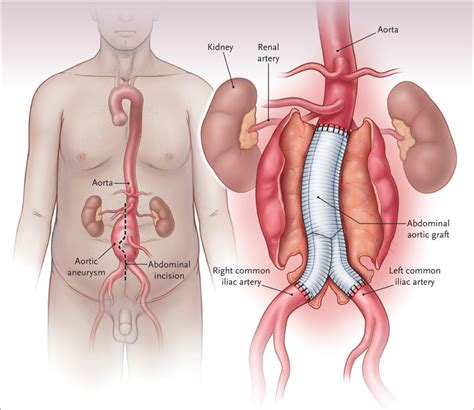 Management of Abdominal Aortic Aneurysms | NEJM