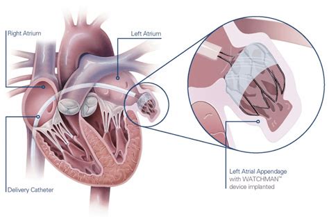 Atrial Appendage Closure | Duncanville, TX | Premier Cardiovascular