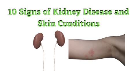 10 Signs Of Kidney Disease And Skin Conditions – Turn To Be Healthy