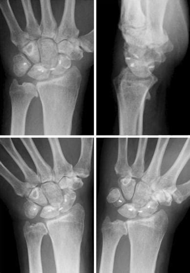 Radiographs at the 1-year follow-up. The scapholunate a | Open-i