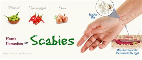 Top 20 Natural Home Remedies For Scabies Treatment In Humans