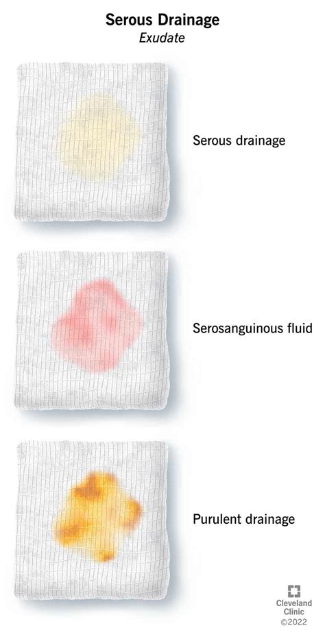 Types Of Wound Drainage