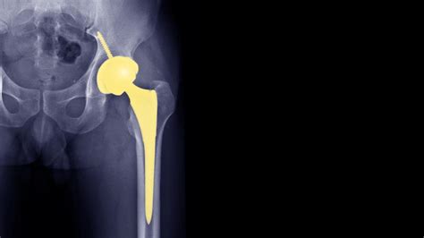 All about joint replacement surgery