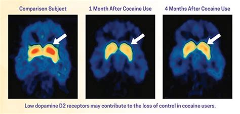 Drug Misuse and Addiction | National Institute on Drug Abuse (NIDA)