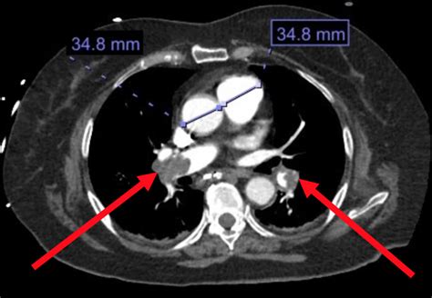 Cureus | Massive Pulmonary Embolism in a Recent Intracranial Hemorrhage ...