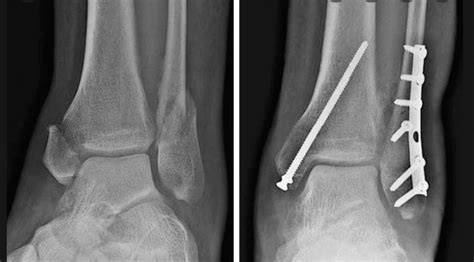 Bimalleolar ankle fracture surgery - enstat