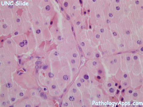 oncocytoma pathology