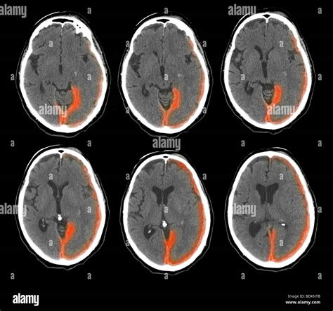 CT scan of the brain of a 73 year old man show intracranial bleeding ...