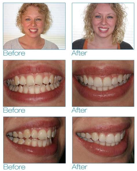 Six Month Smiles in Brooklyn - EnvySmile Dental Spa