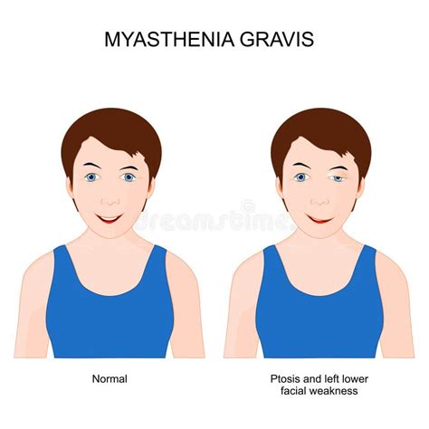 Myasthenia Gravis Symptoms Stock Illustrations – 6 Myasthenia Gravis ...