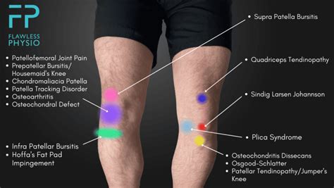 Knee Pain Location Chart - Find the Cause of Your Knee Pain