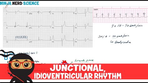 Accelerated Junctional Rhythm