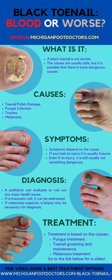 Black Toenail Treatment: [Causes, Symptoms & Remedy!]