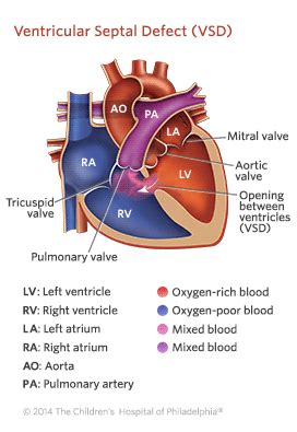 Ventricular Septal Defect (VSD) | Children's Hospital of Philadelphia