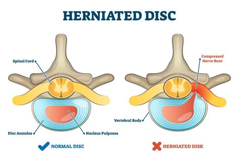 What is a Herniated Disc? - William Capicotto, MD