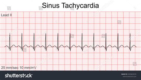 Sinus Tachycardia