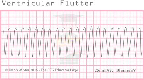 ECG Educator Blog : Ventricular Rhythms