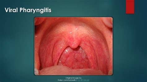 Glory Info About How To Treat Viral Pharyngitis - Commonlab23