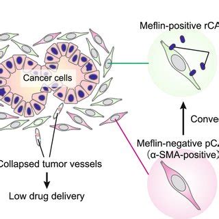 Representative histology of human pancreatic ductal adenocarcinoma ...