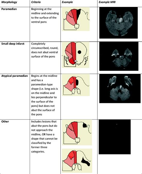 Medial Pontine Syndrome