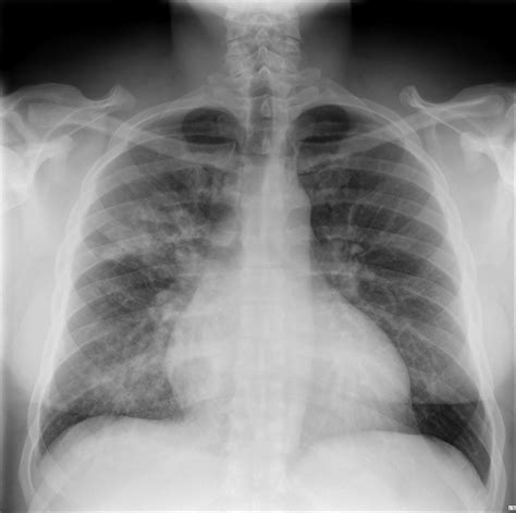 Bronchopneumonia Vs Lobar Pneumonia