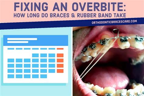 How Long Do Braces Take To Fix An Overbite? - Orthodontic Braces Care