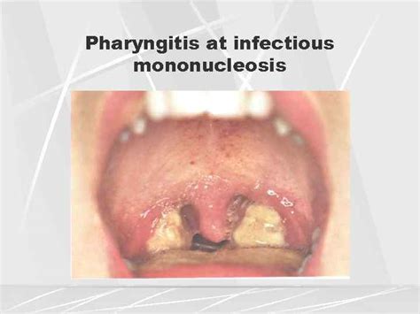 Differential diagnosis of pharyngitis Main inflammatory throat