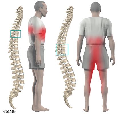 Thoracic Disc Herniation - eOrthopod.com