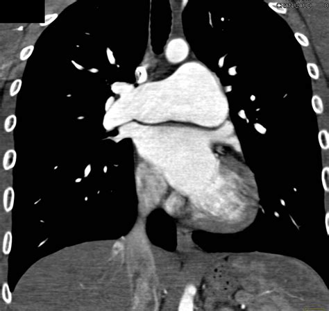 Enlarged Main Pulmonary Artery - Chest Case Studies - CTisus CT Scanning