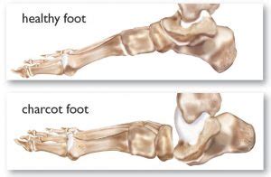 Diabetic Foot Conditions: Charcot Foot | Best Podiatrists Los Angeles