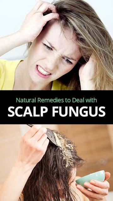 Home Remedies For Scalp Fungus Infection