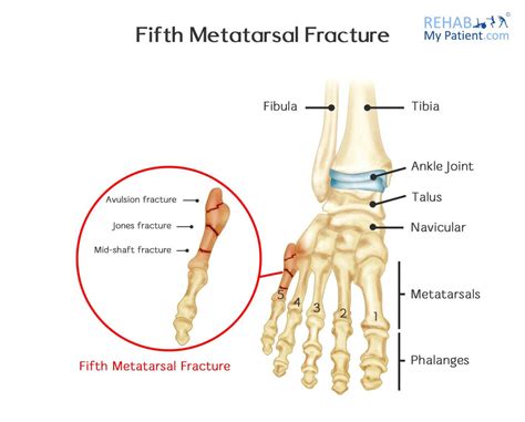 Tuberosity Of 5th Metatarsal Pain