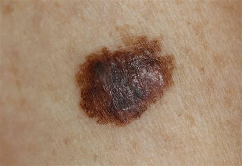 Skin Cancer: Signs, Symptoms, and Complications