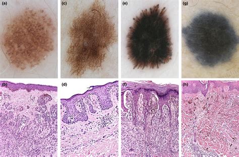 Junctional Melanocytic Nevus