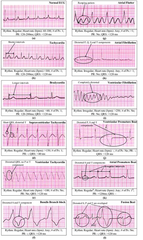 An illustrative description of different arrhythmias [Thaler 2015]: (a ...