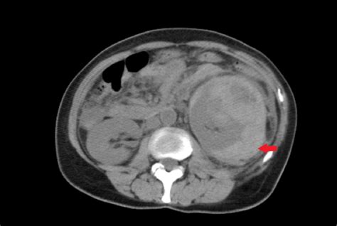 Retroperitoneal Hematoma