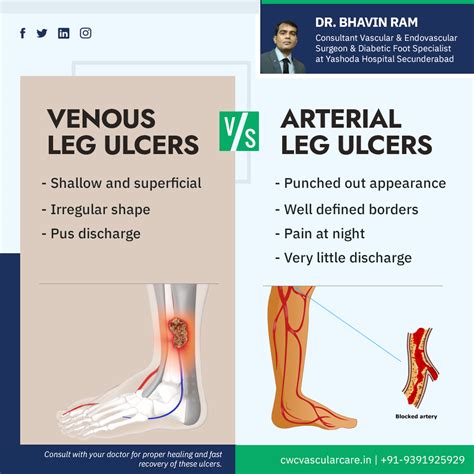 Venous Stasis Ulcer Treatment Pictures Causes Symptoms