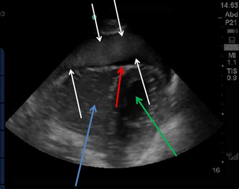 Dr. Smith's ECG Blog: 30 Year Old with Cardiac Arrest, PEA, then ...