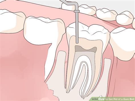 How to Get Rid of a Gum Boil: 10 Steps (with Pictures) - wikiHow