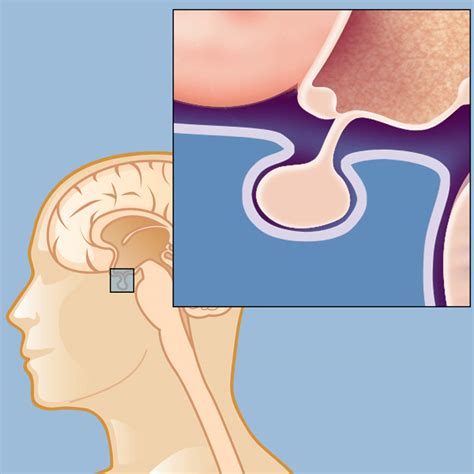 Prolactinoma | Brain & Spine Center