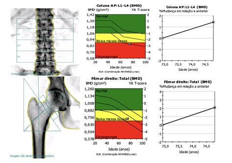 Densitometria Óssea Medicina Diagnóstica | Exames de Imagem - Porto ...