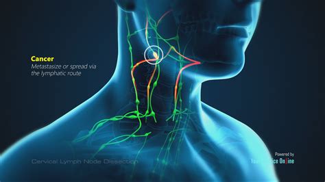 Lymph Node Lump On Neck