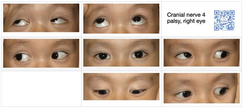 Cranial Nerve Palsy | 3rd nerve palsy | 4th nerve palsy | 6th nerve palsy