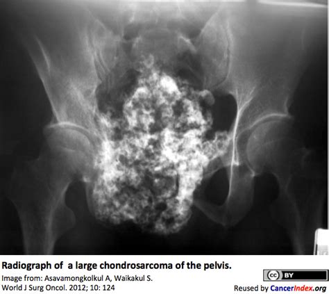 Chondrosarcoma Mri